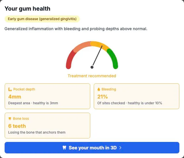 Alta Voice sample report summary with a gum-health gauge, deepest pocket of 4 mm, bleeding at 21% of sites checked, bone loss flagged at six teeth, and a link to the 3D view.