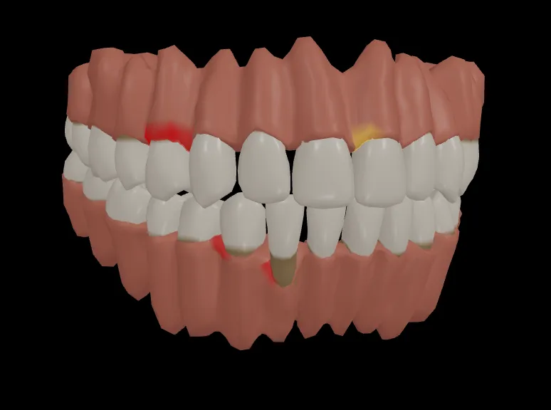 3D Perio Index — color-coded periodontal model